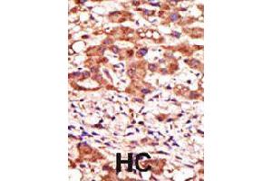 Formalin-fixed and paraffin-embedded human hepatocellular carcinoma tissue reacted with MGAT1 polyclonal antibody  , which was peroxidase-conjugated to the secondary antibody, followed by AEC staining . (MGAT1 抗体  (N-Term))