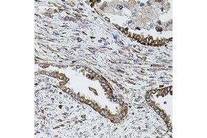 Immunohistochemistry of paraffin-embedded human lung cancer using SHH antibody.