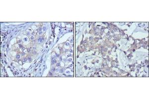 Immunohistochemical analysis of paraffin-embedded human lung cancer (left) and breast cancer (right) using RTN3 mouse mAb with DAB staining. (Reticulon 3 抗体)