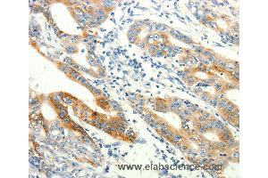 Immunohistochemistry of Human lung cancer using TRPA1 Polyclonal Antibody at dilution of 1:60 (TRPA1 抗体)