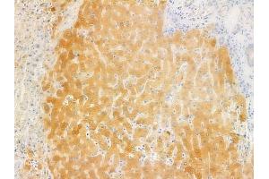 ABIN6262117 and ABIN6278010 at 1/100 staining human hepatocellular carcinoma by IHC-P.