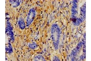 Immunohistochemistry of paraffin-embedded human colon cancer using ABIN7154609 at dilution of 1:100 (ERAL1 抗体  (AA 271-382))