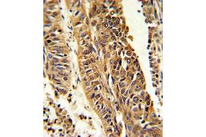 Formalin-fixed and paraffin-embedded human lung carcinoma reacted with CYP4B1 Antibody (Center) (ABIN652592 and ABIN2842397) , which was peroxidase-conjugated to the secondary antibody, followed by DAB staining. (CYP4B1 抗体  (AA 331-362))