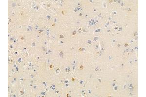 ABIN6266116 and ABIN6278648 at 1/100 staining human glioblastoma by IHC-P. (ZNF23 抗体  (Internal Region))