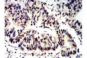Immunohistochemical analysis of paraffin-embedded rectum cancer tissues using Phospho-4E-BP1 (Ser65) mouse mAb with DAB staining. (eIF4EBP1 抗体  (pSer65))