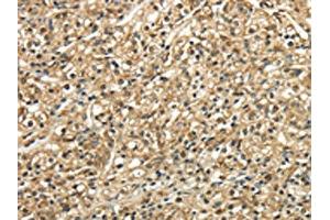 The image on the left is immunohistochemistry of paraffin-embedded Human prostate cancer tissue using ABIN7128049(TSC22D1 Antibody) at dilution 1/30, on the right is treated with fusion protein. (TSC22D1 抗体)