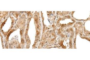 Immunohistochemistry of paraffin-embedded Human thyroid cancer tissue using ZUFSP Polyclonal Antibody at dilution of 1:35(x200) (ZUFSP 抗体)