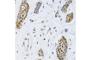Immunohistochemistry of paraffin-embedded human breast cancer using CIRBP antibody (ABIN5973938) at dilution of 1/100 (40x lens). (CIRBP 抗体)