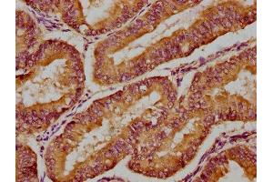 IHC image of ABIN7160647 diluted at 1:300 and staining in paraffin-embedded human endometrial cancer performed on a Leica BondTM system. (MTMR3 抗体  (AA 652-899))