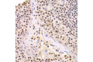 Immunohistochemistry of paraffin-embedded human amygdalitis using HMGB1 Antibody. (HMGB1 抗体  (AA 100-200))