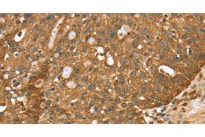 Immunohistochemistry of paraffin-embedded Human breast cancer using STARD5 Polyclonal Antibody at dilution of 1:40 (STARD5 抗体)