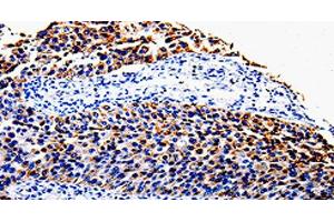 Immunohistochemistry of paraffin-embedded Human renal cancer tissue using COX10 Polyclonal Antibody at dilution 1:100 (COX10 抗体)