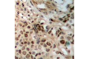 Immunohistochemical analysis of JAK2 staining in human breast cancer formalin fixed paraffin embedded tissue section. (JAK2 抗体)