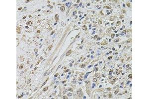 Immunohistochemistry of paraffin-embedded Human prostate cancer using SMARCC2 Polyclonal Antibody at dilution of 1:100 (40x lens). (SMARCC2 抗体)