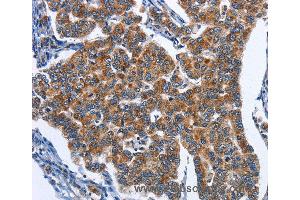 Immunohistochemistry of Human colon cancer using CADM3 Polyclonal Antibody at dilution of 1:40 (CADM3 抗体)