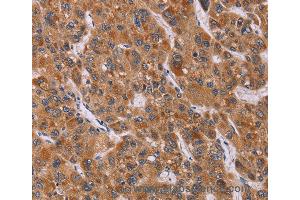 Immunohistochemistry of Human breast cancer using CALCA Polyclonal Antibody at dilution of 1:40 (CGRP 抗体)
