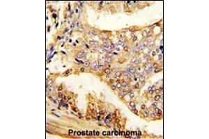 Formalin-fixed and paraffin-embedded human prostate carcinoma reacted with PUM2 Antibody , which was peroxidase-conjugated to the secondary antibody, followed by DAB staining. (PUM2 抗体  (AA 159-189))