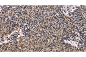Immunohistochemistry of paraffin-embedded Human ovarian cancer using EVC2 Polyclonal Antibody at dilution of 1:40 (EVC2 抗体)