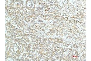 Immunohistochemical analysis of paraffin-embedded Human Breast Carrcinoma Tissue using a-actinin Mouse mAb diluted at 1:200. (ACTN1 抗体)