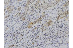 ABIN6272589 at 1/100 staining Human lung cancer tissue by IHC-P. (IL1F9 抗体  (N-Term))