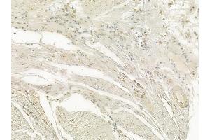 ABIN6256874 and ABIN6274505 at 1/100 staining human esophageal carcinoma by IHC-P.