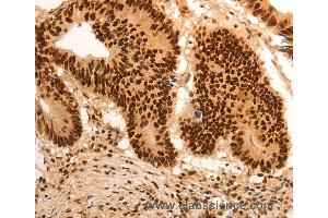 Immunohistochemistry of Human gastic cancer using E2F7 Polyclonal Antibody at dilution of 1:60 (E2F7 抗体)