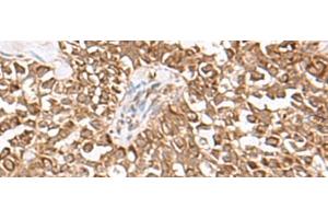 Immunohistochemistry of paraffin-embedded Human ovarian cancer tissue using USP16 Polyclonal Antibody at dilution of 1:25(x200) (USP16 抗体)
