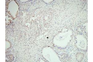 SNAI2 Antibody(ABIN6276471) staining human ovarian cancer tissue sections by IHC-f at 1:200. (SLUG 抗体  (Internal Region))