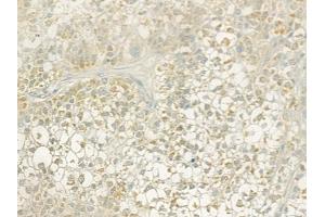 ABIN6256934 and ABIN6274825 at 1/100 staining human hepatocellular carcinoma by IHC-P. (ALDH3B1 抗体  (N-Term))
