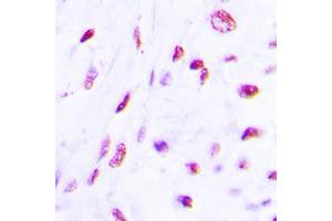 Immunohistochemical analysis of C/EBP beta (pT235) staining in human lung cancer formalin fixed paraffin embedded tissue section. (CEBPB 抗体  (pSer235))