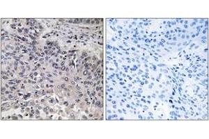 Immunohistochemistry analysis of paraffin-embedded human lung carcinoma tissue, using C1QC Antibody.