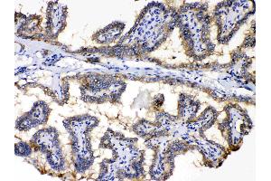 PDE5A was detected in paraffin-embedded sections of human thyroid cancer tissues using rabbit anti- PDE5A Antigen Affinity purified polyclonal antibody (Catalog # ) at 1 µg/mL. (PDE5A 抗体  (N-Term))