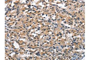 The image on the left is immunohistochemistry of paraffin-embedded Human thyroid cancer tissue using ABIN7189631(ACPT Antibody) at dilution 1/30, on the right is treated with synthetic peptide. (Testicular Acid Phosphatase (ACP4) 抗体)