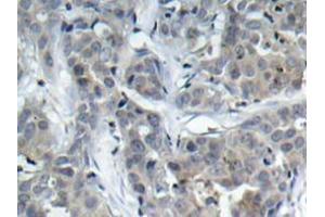 Immunohistochemistry analyzes of Op18 antibody in paraffin-embedded human breast carcinoma tissue. (Stathmin 1 抗体)
