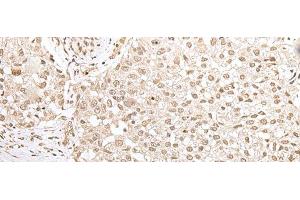 Immunohistochemistry of paraffin-embedded Human lung cancer tissue using ZKSCAN3 Polyclonal Antibody at dilution of 1:50(x200) (ZKSCAN3 抗体)