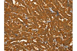 The image on the left is immunohistochemistry of paraffin-embedded Human thyroid cancer tissue using ABIN7130796(PYGM Antibody) at dilution 1/30, on the right is treated with fusion protein. (PYGM 抗体)