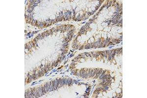 Immunohistochemistry of paraffin-embedded human rectal cancer using TPM2 antibody (ABIN5971583) at dilution of 1/200 (40x lens). (TPM2 抗体)