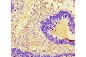 Immunohistochemistry of paraffin-embedded human ovarian cancer using ABIN7173135 at dilution of 1:100 (TMEM27 抗体  (AA 73-146))