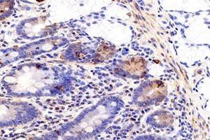 Immunohistochemistry analysis of paraffin-embedded human colon cancer using MIIP (ABIN7074626) at dilution of 1: 1200 (MIIP 抗体)