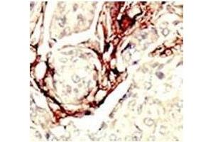 IHC analysis of FFPE human breast carcinoma tissue stained with the LKB1 antibody (LKB1 抗体  (AA 14-44))