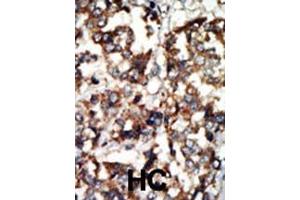 Formalin-fixed and paraffin-embedded human cancer tissue reacted with the primary antibody, which was peroxidase-conjugated to the secondary antibody, followed by DAB staining. (ATM 抗体  (N-Term))