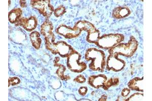 Formalin-fixed, paraffin-embedded human prostate carcinoma (20X) stained with AMACR / p504S Rabbit Monoclonal Antibody (13H4) (AMACR 抗体)