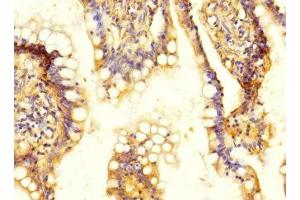 Immunohistochemistry of paraffin-embedded human colon cancer using ABIN7170096 at dilution of 1:100 (SLC13A2 抗体  (AA 345-455))