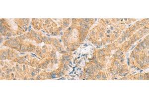 Immunohistochemistry of paraffin-embedded Human thyroid cancer tissue using NCOA4 Polyclonal Antibody at dilution of 1:130(x200) (NCOA4 抗体)