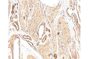 IHC: human leiomyosarcoma stained with Smooth muscle actin antibody (1A4). (Smooth Muscle Actin 抗体  (N-Term))