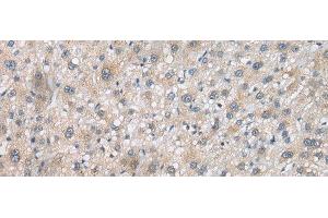 Immunohistochemistry of paraffin-embedded Human liver cancer tissue using PSMF1 Polyclonal Antibody at dilution of 1:30(x200) (PSMF1 抗体)