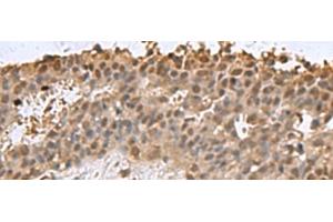 Immunohistochemistry of paraffin-embedded Human breast cancer tissue using DCTPP1 Polyclonal Antibody at dilution of 1:85(x200) (DCTPP1 抗体)