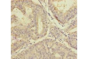 Immunohistochemistry of paraffin-embedded human endometrial cancer using ABIN7163315 at dilution of 1:100