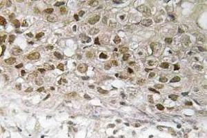 Immunohistochemistry (IHC) analyzes of p-MEK1 antibody in paraffin-embedded human breast carcinoma tissue. (MEK1 抗体  (pThr292))