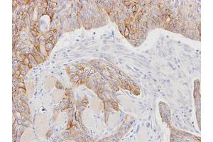 IHC-P Image Immunohistochemical analysis of paraffin-embedded HSC3 xenograft, using CD147, antibody at 1:100 dilution. (CD147 抗体)